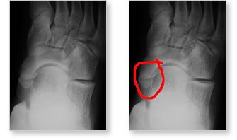 foot navicular accessory bone xr extra syndrome right pain adolescent above