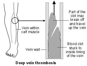 gastrocnemius vein dvt