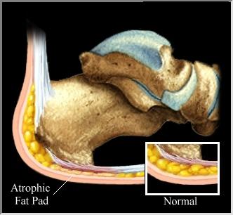 heel fat pad syndrome treatment