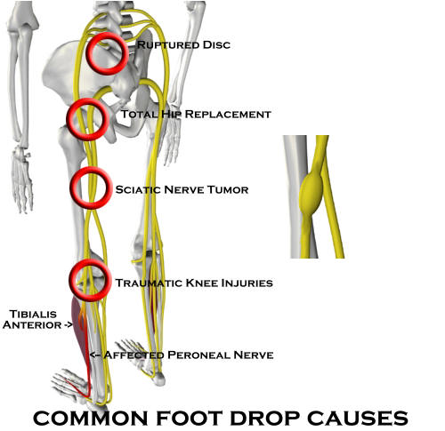 CalexFit, Foot Pain Relief Center - Conditions - Foot Drop (Drop Foot)