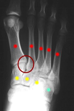 CalexFit, Foot Pain Relief Center - Conditions - Lisfranc Fractures