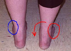 CalexFit, Foot Pain Relief Center - Conditions - Foot Drop (Drop Foot)