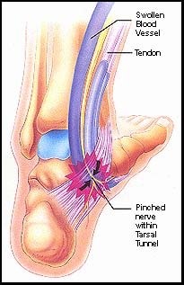 CalexFit, Foot Pain Relief Center - Conditions - Foot Drop (Drop Foot)